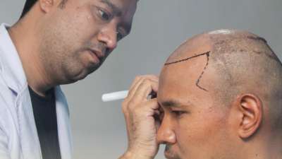 Hair Transplants: Separating Myth from Fact